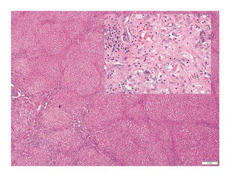 Photomicrographs Of Hepatic Epithelioid Hemangioendothelioma A This Download Scientific