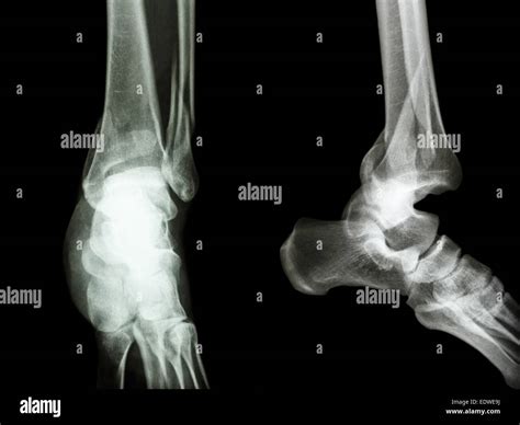 Lateral Distal Tibia Fracture