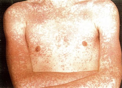 Infectious Mononucleosis Rash Amoxicillin