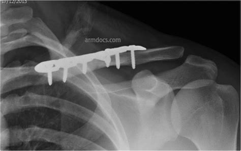 Clavicle Fracture Plate Fixation Arm Docs