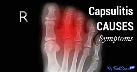 What Is Capsulitis Of The Second Toe And How Is It Caused? | Healthier Land