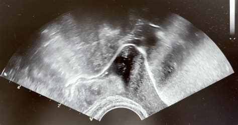 Hycosy After Reversal Female Sterilization Reversals