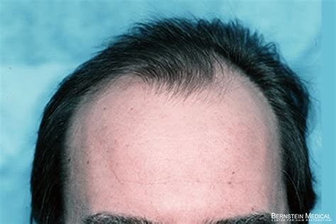 Patient Ahb Bernstein Medical Center For Hair Restoration