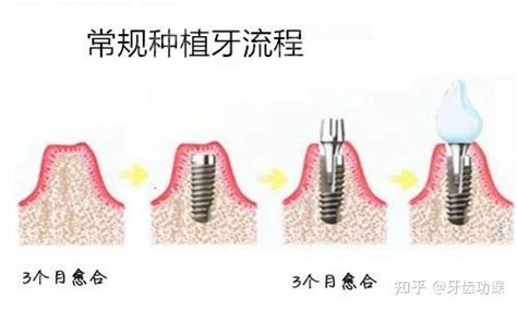 拔完牙多久可以做种植牙？来参考拔牙后种植牙最佳时期 知乎