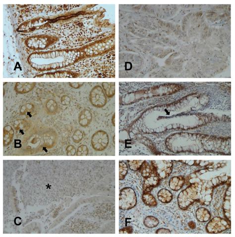 ERβ expression in colonic mucosa from CD UC patients Light microscopic