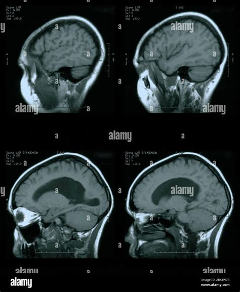 Hydrocephalus Mri