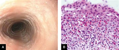 Racgp A Gp Primer For Understanding Upper Gastrointestinal Tract Biopsy Reports