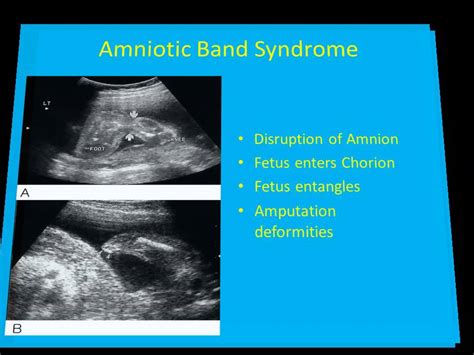 36 Placenta Imaging Part 2 Dr Ahmed Esawy Youtube