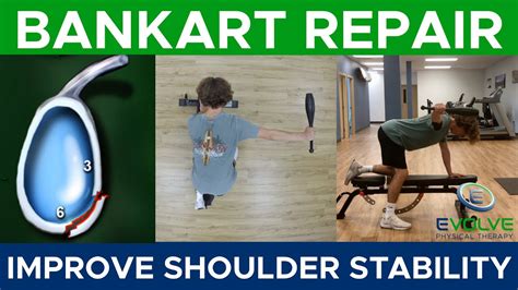 Bankart Repair Improving Shoulder Girdle Strength Part 6 Youtube