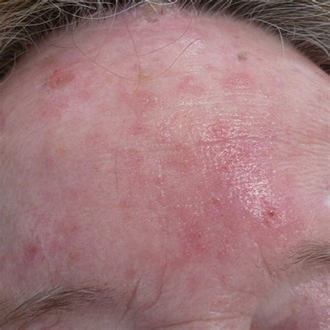 Aktinische Keratose Dermatologie am Dom München