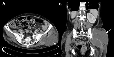 Gas Forming Gluteal Abscess After Intramuscular Self Injections Due To