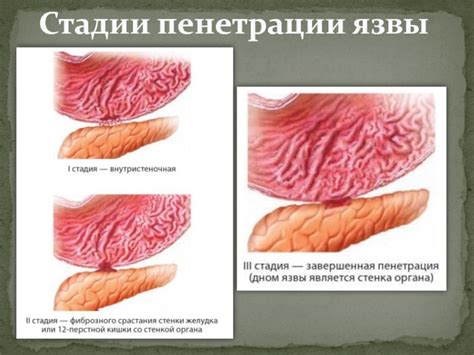 Пенетрация язвы