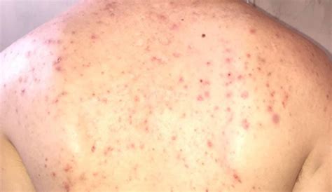 Home Remedies For Back Acne How To Get Rid Of Back Acne At Home In