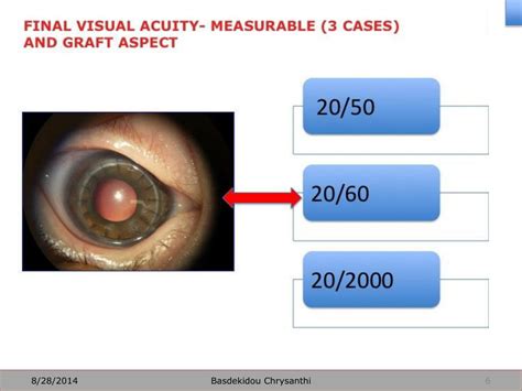 Ppt Penetrating Keratoplasty For Unilateral Corneal Opacities In