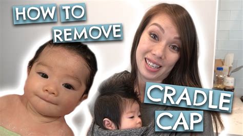 Baby Has Cradle Cap What We Use And Removal Youtube