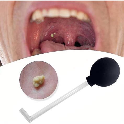 Tonsil Stone Remover Vakuum Tonsil Stone Removal Kit Verktyg Tonsil