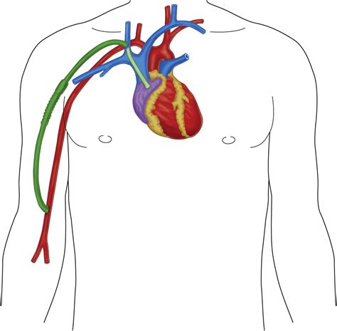 A Review On The Hemodialysis Reliable Outflow Hero Graft For