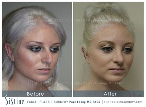 Restylane Juvederm Before And After 10 Sistine Facial Plastic Surgery