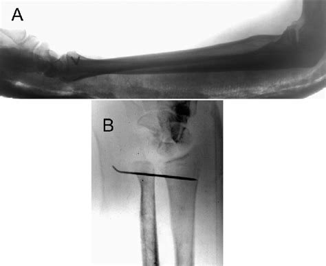 Post Operative Lateral Radiograph Of The Forearm A And Download