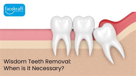 Wisdom Teeth Removal Before And After Face