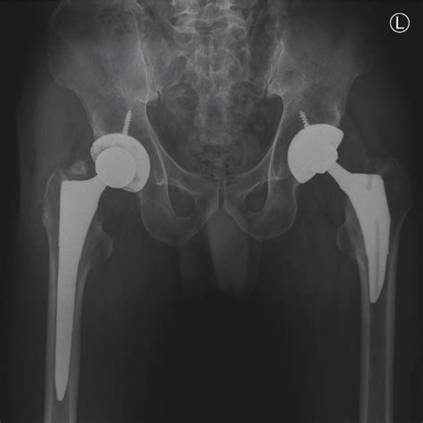 Ap Radiographs Of The Pelvis Taken Years Post Surgery Following