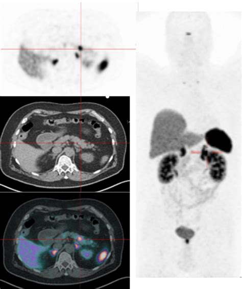 Ga Dotatoc Pet Ct Imaging Detecting A Mm Well Differentiated Net