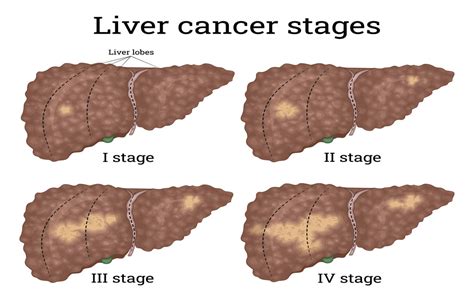 The Different Stages Of Liver Cancer Usa Oncology Centers