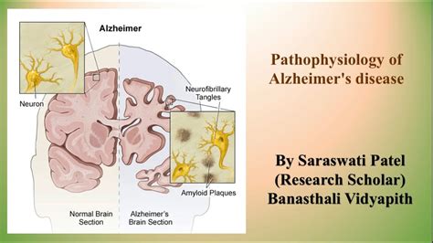 Pathophysiology Of Alzheimer Disease