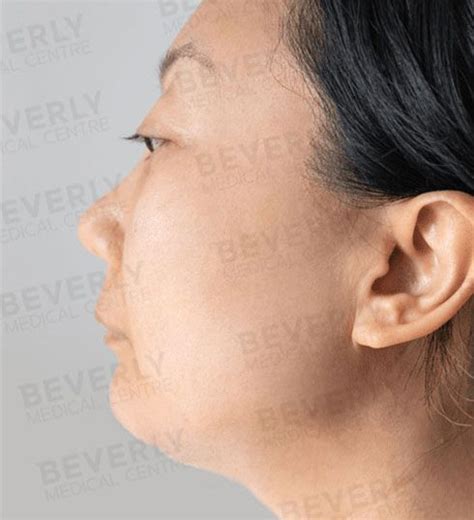 Rediscover Your Youth With Facelift Surgery At Beverly Wilshire