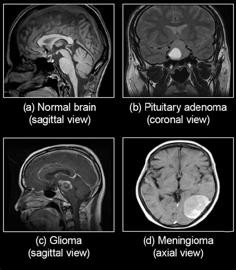 Mri Scans Of The Normal Brain And Brain Have Different Tumorous Growth