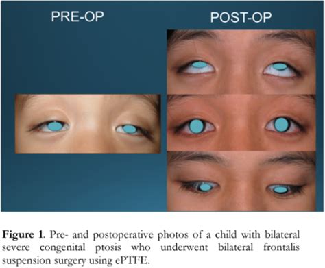 Bilateral Frontalis Sling For Surgical Correction Of Unilateral And Bilateral Severe Congenital