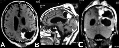 Clinical Photograph Showing Multiple Scalp Nodule Near To The