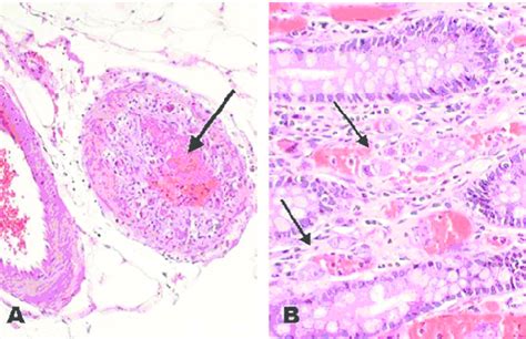 Large Bowel A A Submucosal Vein Shows Cmv Vasculitis With