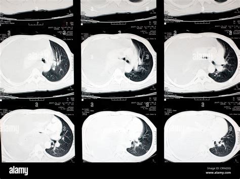 Tomografía computarizada de tórax fotografías e imágenes de alta