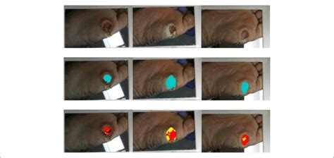 Wound area and tissue classification results for patient 2. Row 1 ...