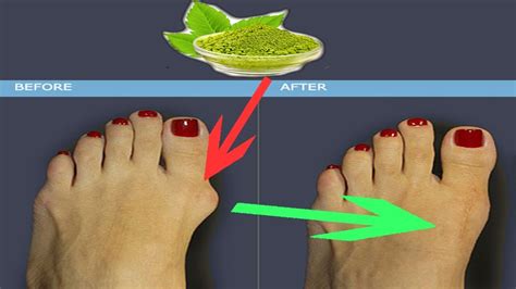 Bunion How To Get Rid Of A Bunion Naturally At Home Treat Bunions