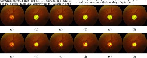 Figure From Two Stage U Net For Optic Disc Cup Segmentation