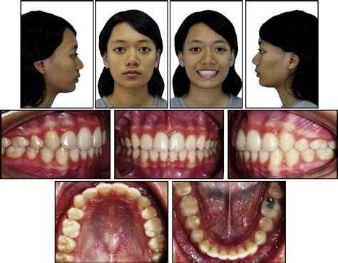 Figure From Treatment Of A Severe Class Ii Division Malocclusion