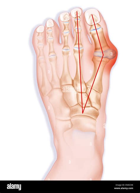 Deformidad Del Pie Humano Hallux Valgus Fotograf As E Im Genes De Alta