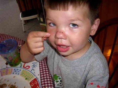 Kid With Fork Stuck In His Nose