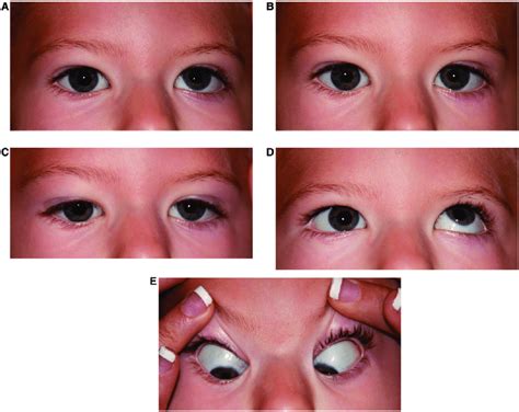 Superior Gaze Palsy