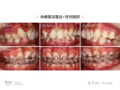 重庆牙齿矫正（正畸）【案例】—深覆合牙列不齐牙列拥挤 知乎