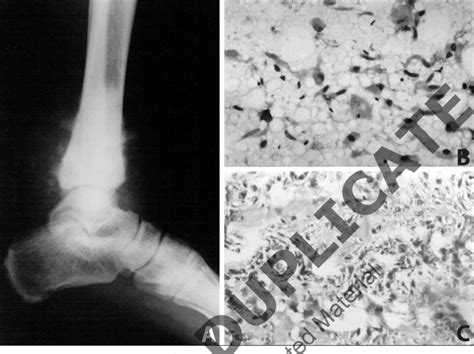 Parosteal OS A Radiograph Showing Periosteal New Bone Formation At