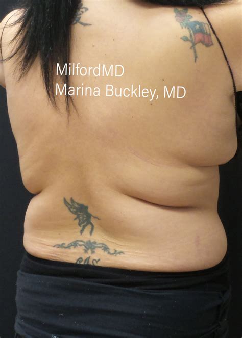 Coolsculpting Love Handles Before And After Case