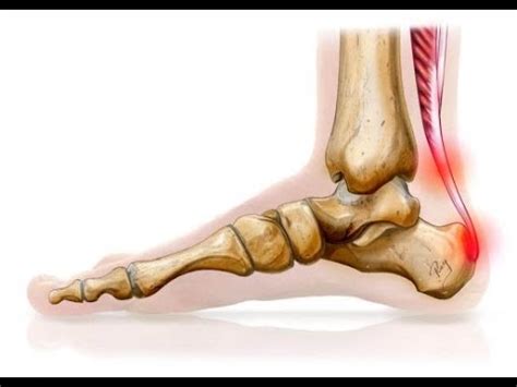 Achilles Tendonitis Total Foot And Ankle Clinic YouTube