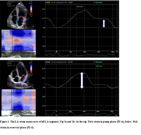 Early Detection Of Left Atrial Dysfunction In Hypertensive Patients