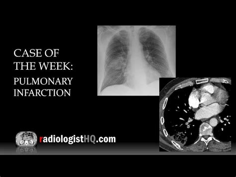 Pulmonary Infarction X Ray