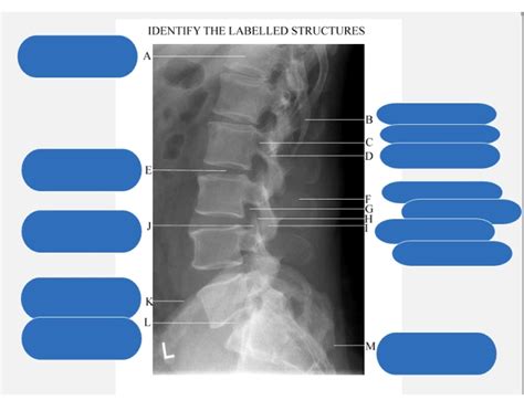 Lateral L Spine (x-ray) Quiz