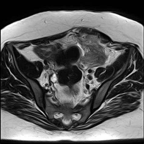 Tubo Ovarian Abscess Following Cesarian Section Image