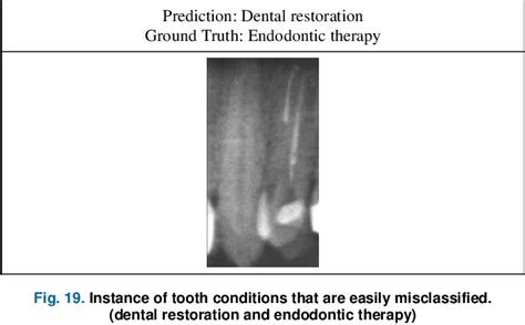 Figure 19 From Tooth Numbering And Condition Recognition On Dental Panoramic Radiograph Images